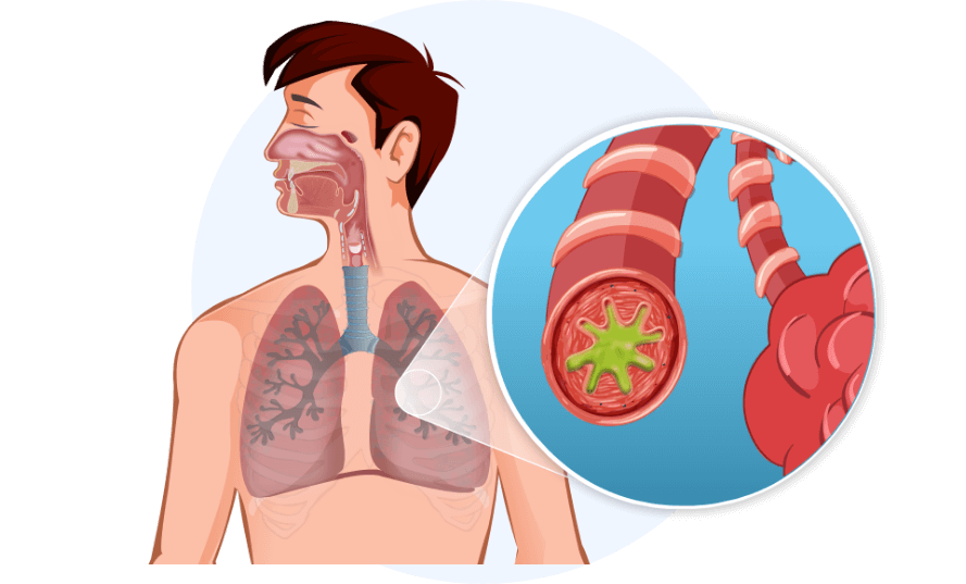 Illustration of man with viruses in bronchi